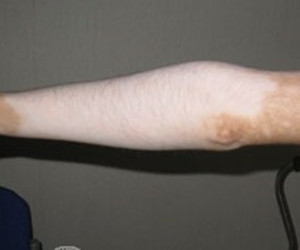 肢端型白癜风发病原因有哪些