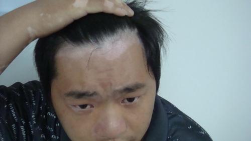 北京白癜风康复中心：男性白癜风有什么影响