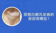 北京白癜风医院医生指导治疗颈部白癜风的偏方