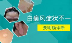 北京白癜风专家介绍怎样能使患者的白斑好转的