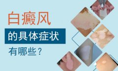 北京白癜风病医院解析白癜风会引发的四种并发
